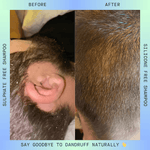 natural shampoo and conditioner for dandruff australia