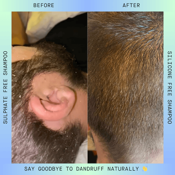 natural shampoo and conditioner for dandruff australia